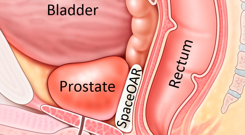 Prostate Treatment