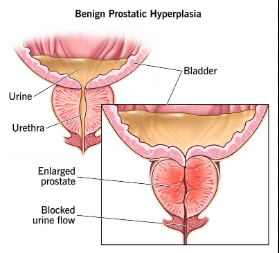 Benign Prostatic Hyperplasia (BPH)